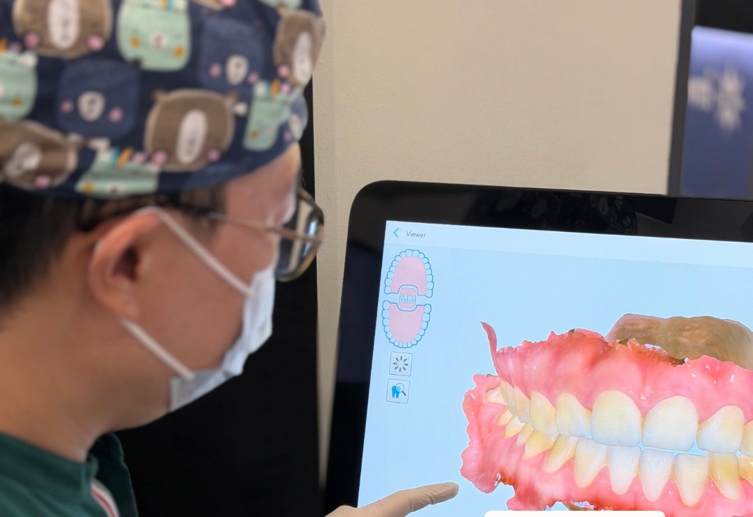 A 3D intraoral scan of an upper arch on screen at Calm Dental, Millenia Walk, used to record tooth surfaces so wear can be measured again later