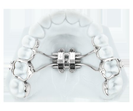 A fixed expander with custom bands, cemented to the upper back teeth on a model