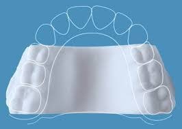 A 3D-printed Invisalign palatal expander, shown on a model of the upper arch