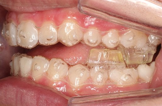 Clear aligners with occlusal blocks in place, seen from the side
