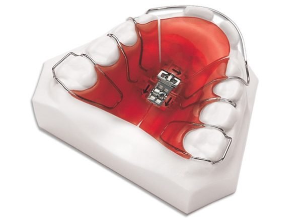 A removable expansion plate with an adjustment screw, shown on a model of the upper arch